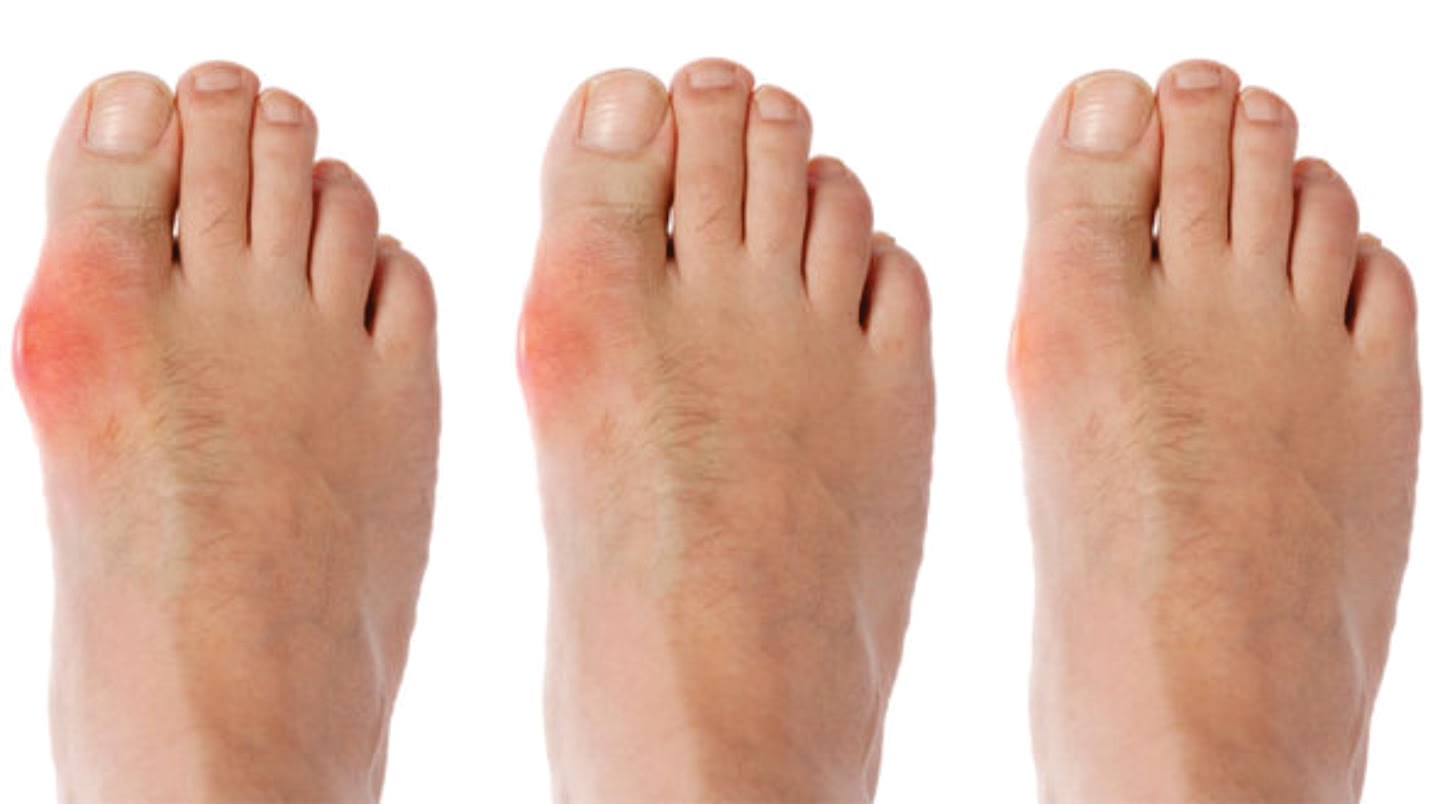 Đối tượng bị bệnh gout