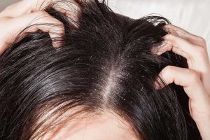 Gầu da đầu và cách điều trị mà bạn nên biết để áp dụng